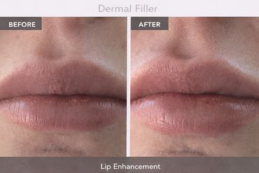 Lip enhancement results after dermal filler