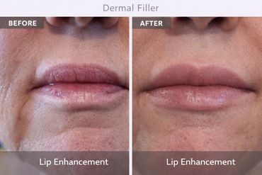 Lip enhancement results after dermal filler