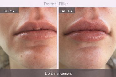 Lip enhancement results after dermal filler