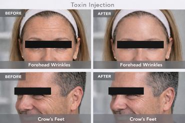 before and after photos of forehead wrinkle and crow feet smoothing after botox injection