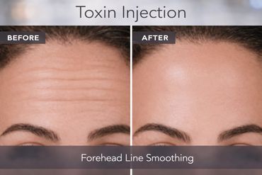 Forehead line smoothing after xeomin injections.