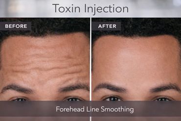 Forehead line smoothing after xeomin injections.