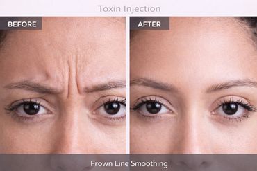 Frown line smoothing results before and after with toxin injection