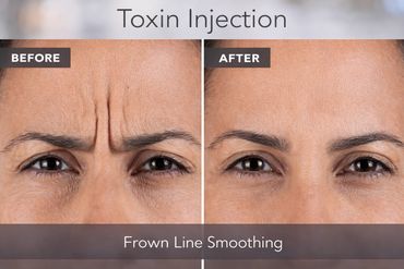 Frown line smoothing results after xeomin toxin injection