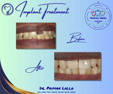 Dental implant trinidad
