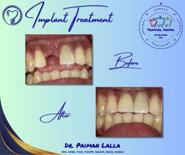 Dental implants trinidad