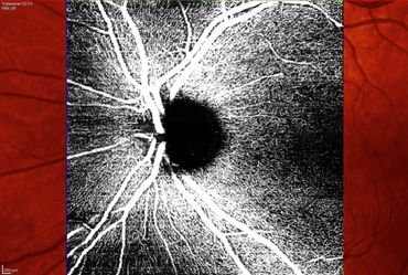 Hudson Valley Glaucoma Care