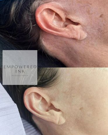 Facelift Scar Camouflage Tattoo