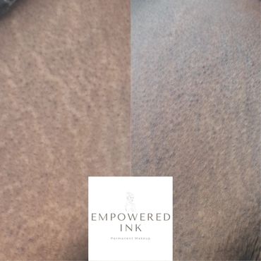 woman, color, dark, black, african, stretch mark removal, revision & rejuvenation