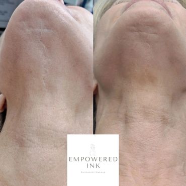 Chin Scar Camouflage Tattoo