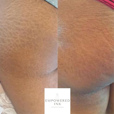 Stretch Mark Camouflage Tattoo