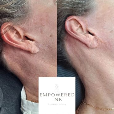facelift Scar Camouflage Tattoo
