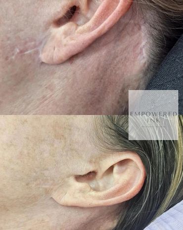Facelift Scar Camouflage Tattoo