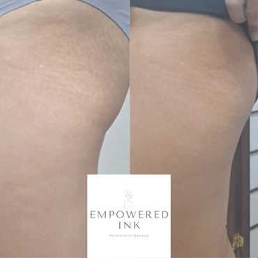buttocks Stretch Mark Removal, Revision & Rejuvenation