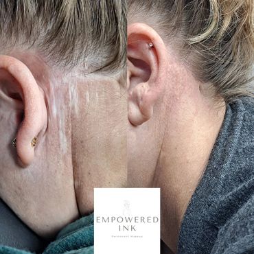 Facelift Scar Camouflage Tattoo