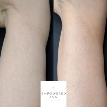 arms Stretch Mark Removal, Revision & Rejuvenation