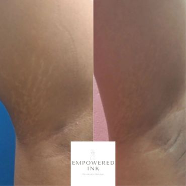 Stretch Mark Camouflage Tattoo