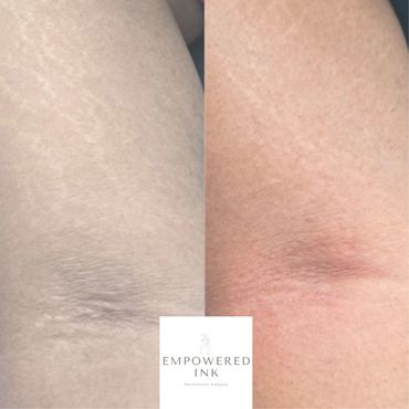 arm - Stretch Mark Removal, Revision & Rejuvenation