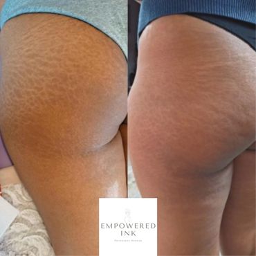 Stretch Mark Camouflage Tattoo