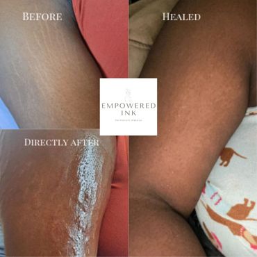 woman, women, color, dark, african, stretch mark removal, revision & rejuvenation