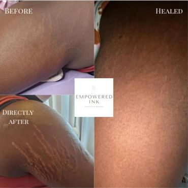 dark skin, STRETCH MARK REMOVAL, REVISION & REJUVENATION