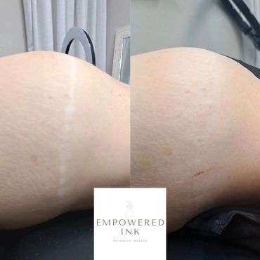 surgery Scar Camouflage Tattoo