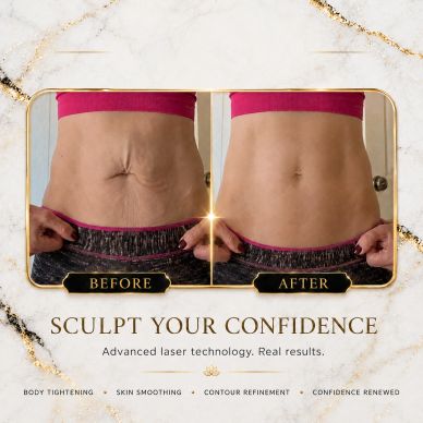 Before and after laser body sculpting results on abdomen.