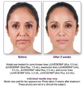 Before and after results
