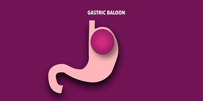 Gastric balloon method for weightloss