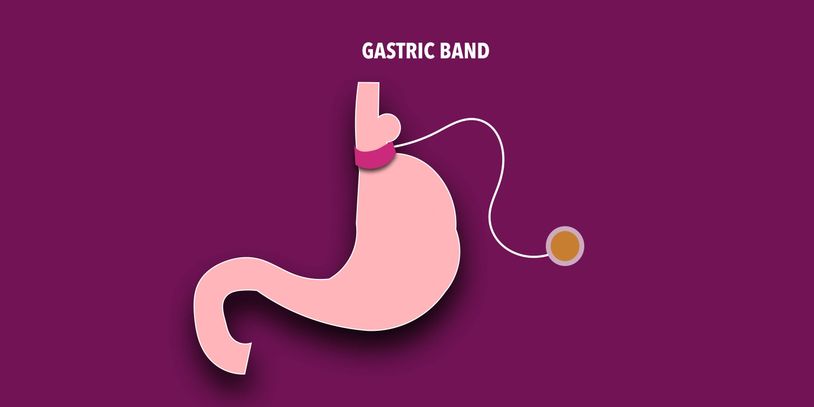 Gastric band for weight loss 