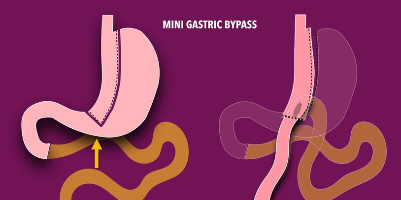 MIni gastric bypass surgery for weight loss