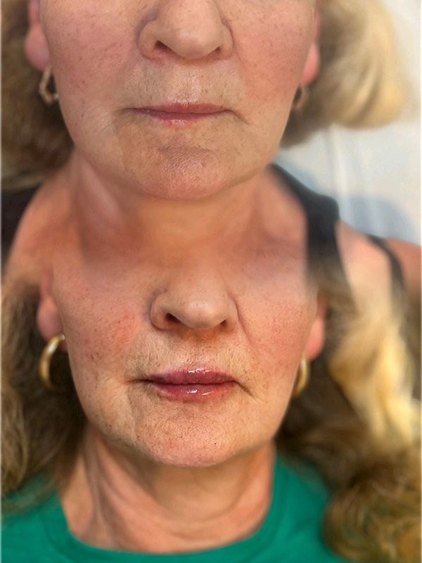 Lip filler in Clacton on sea