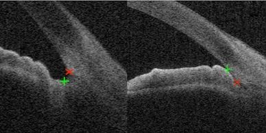 Open vs closed angle by OCT anterior segment imaging, by the Inland Glaucoma Center with eye special