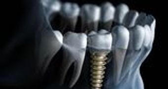 cheap implant, inexpensive implant, cheap implant in brooklyn, cheap implant in crown heights