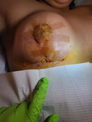 Complications with post op healing office can help you lymphatic massage open on Saturdays