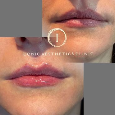 Lip Filler Horsham
Lip Enhancement Horsham
Lip Filler Horsham
Lip Filler Horsham
Lip Filler Horsham