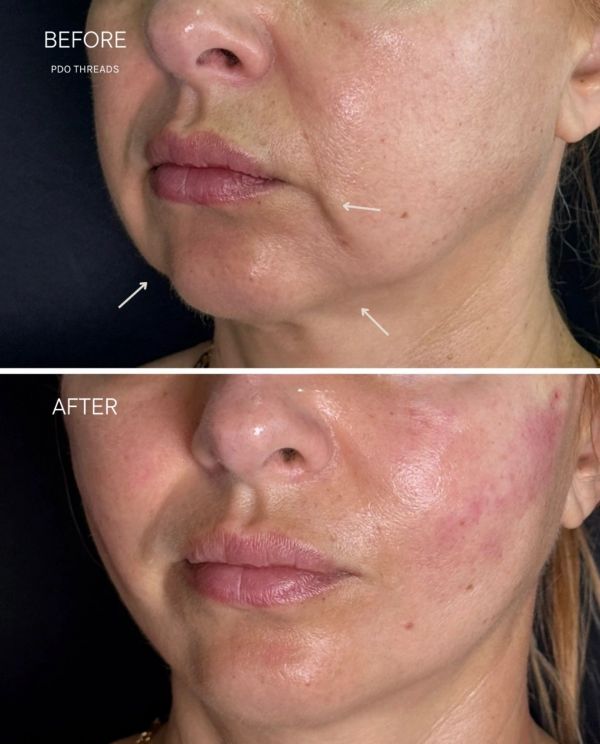 Before and after PDO thread facial treatment showing smoother skin.