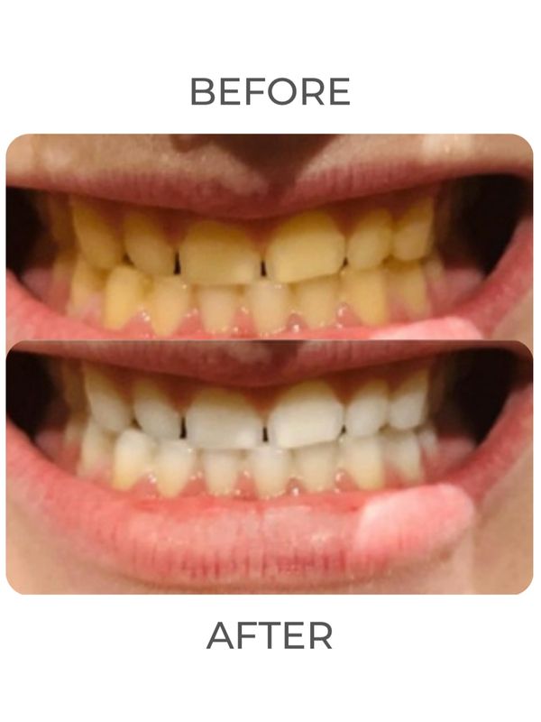 BrightenByBeth offers real, Immediate and long lasting results in the comfort of your own home!