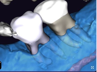 A 3D STL reconstruction AI-generated image of a deep bony defect.