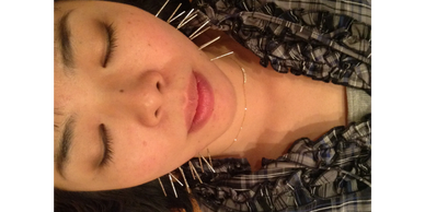 Acupuncture esthétique du visage genevieve Paradis clinique acupuncta