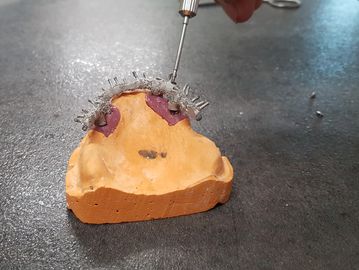 Prótesis Hibrida con resina