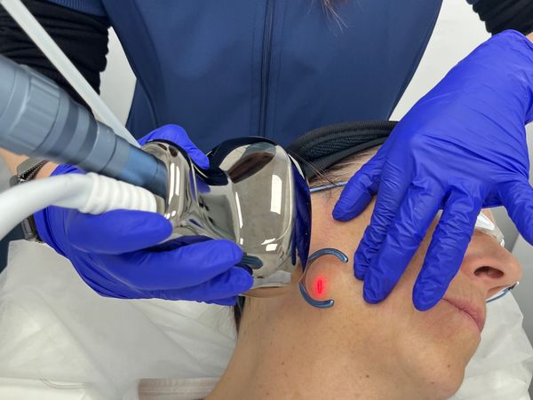 Rejuvenecimiento facial con Laser CO2 fraccionado en Castelldefels