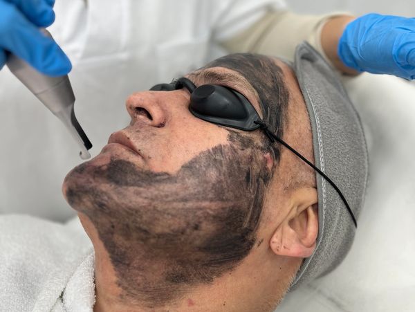 Tratamiento Hollywood peeling con Láser picosegundo en Castelldefels