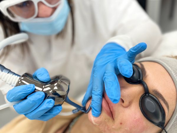 Tratamiento marcas de acné láser CO2 fraccionado