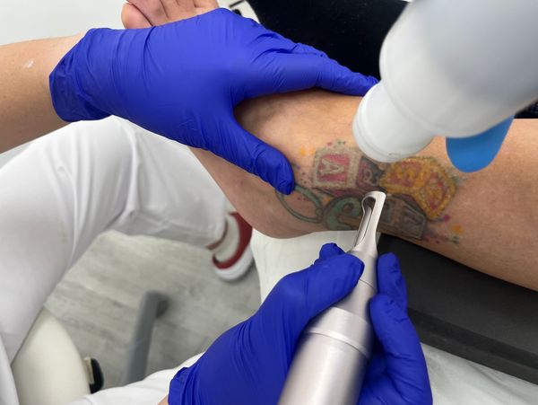Eliminación de tatuaje con Láser Picosegundo en Castelldefels