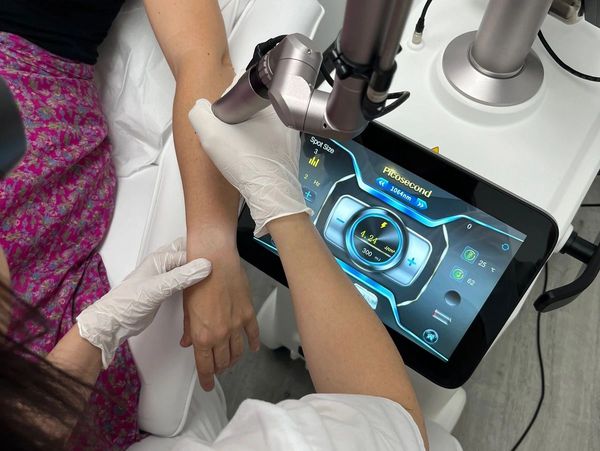 Tratamiento eliminación de manchas con Laser Picosegundo en Castelldefels