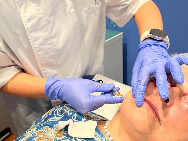 Tratamiento de armonización facial con Acido Hialurónico en Castelldefels