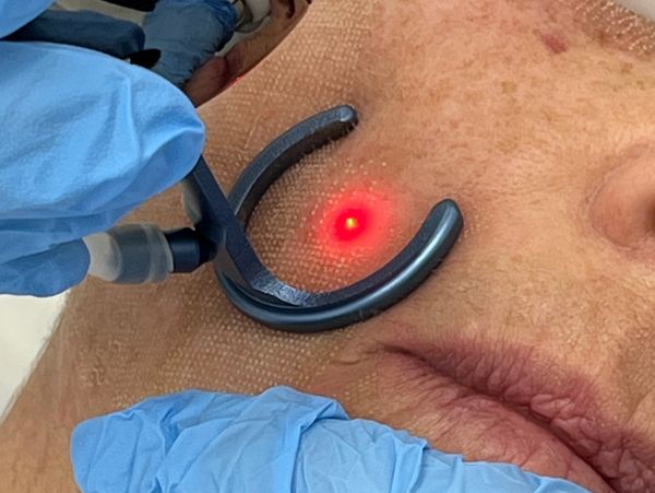 Rejuvenecimiento facial con Láser CO2 fraccionado en Castelldefels