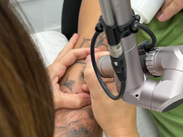 Eliminación de tatuaje con Laser Picosegundo en Castelldefels