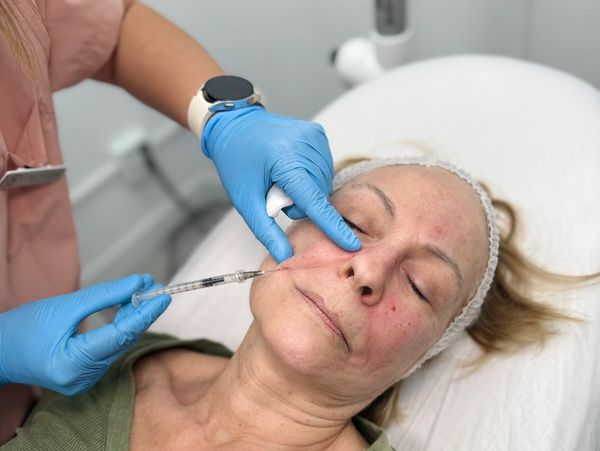 Tratamiento de armonización facial con Acido Hialurónico en Castelldefels